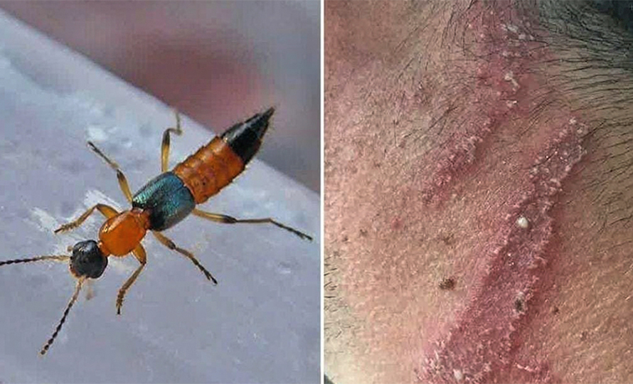 झापामा तीन पालिकामा ‘नाइरोबी फ्लाइ’का सङ्क्रमित भेटिए